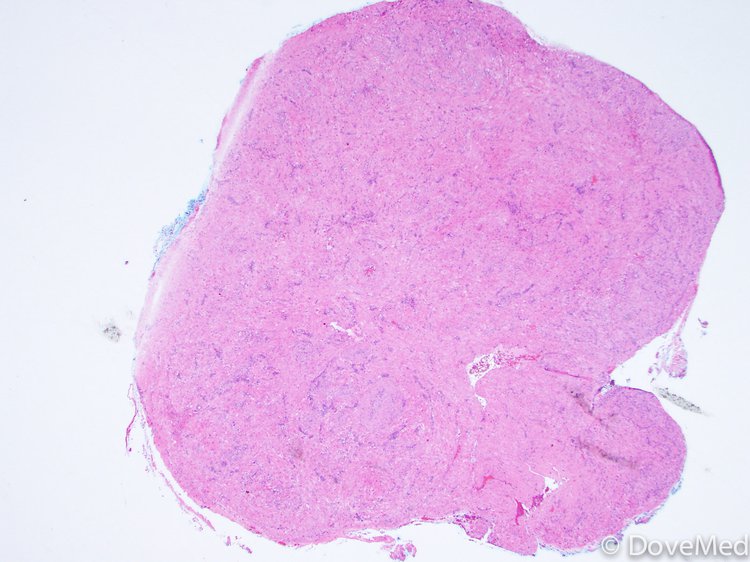 Leiomyoma of Deep Soft Tissue