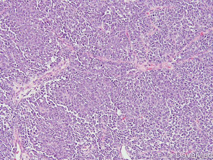 Primary Cutaneous Ewing’s Sarcoma (PCES)