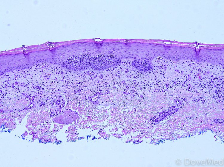 Superficial Basal Cell Carcinoma Of Skin
