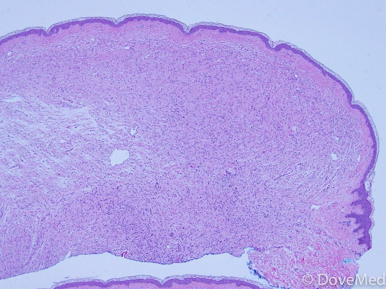 Localized Intraneural Neurofibroma