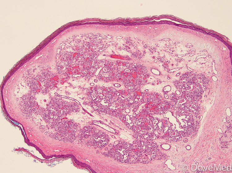 Spindle Cell Hemangioma