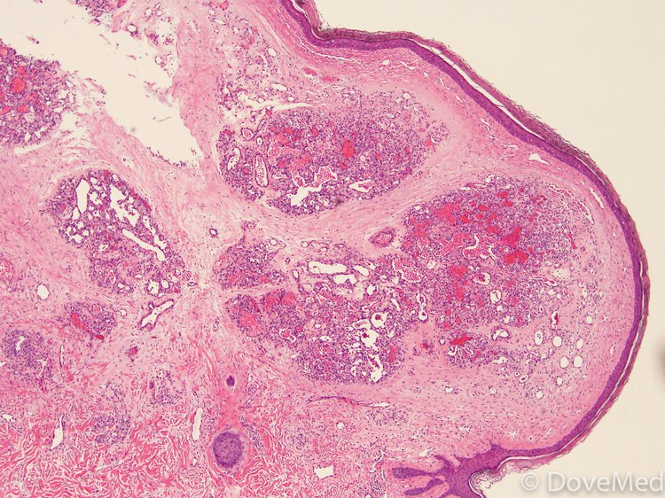 Hemangioma of the Eye