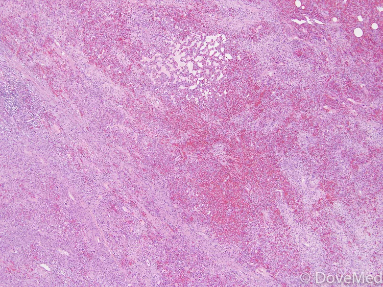 Angiosarcoma of Small Intestine - DoveMed