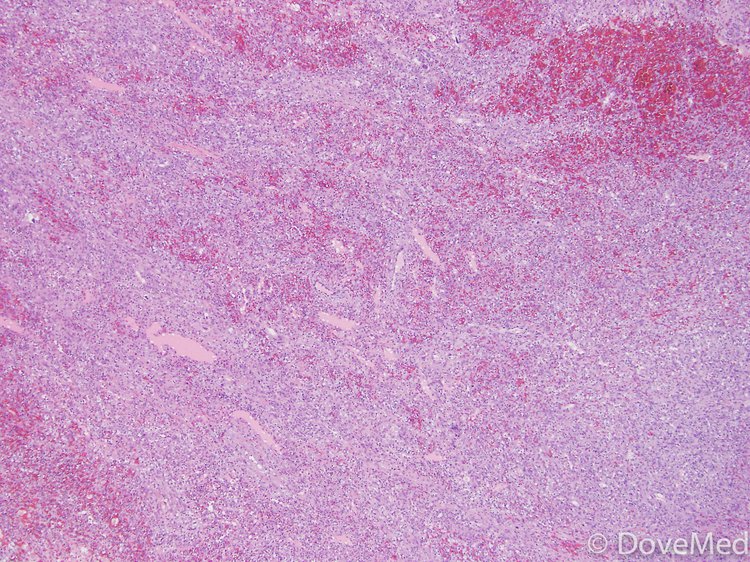 Angiosarcoma Of Skin