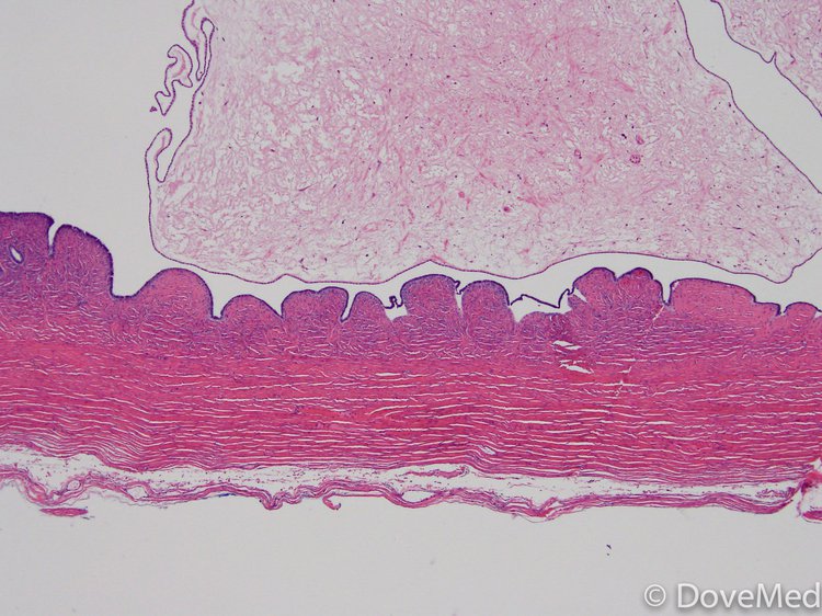 Benign Mucinous Adenofibroma of Ovary