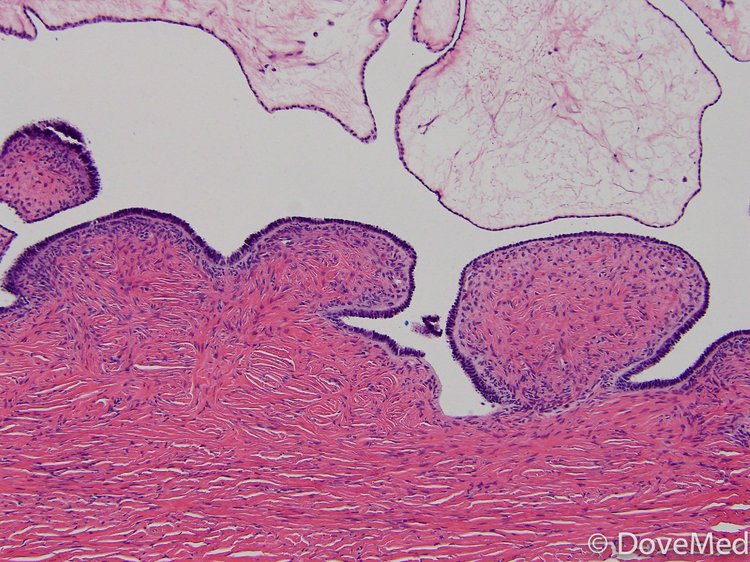 Benign Endometrioid Cystadenofibroma Of Ovary