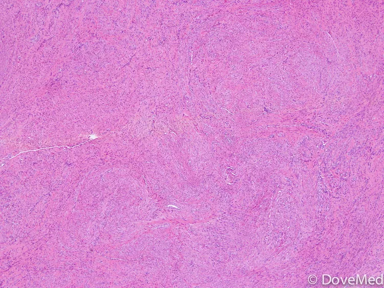 Leiomyoma of Uterine Cervix - DoveMed