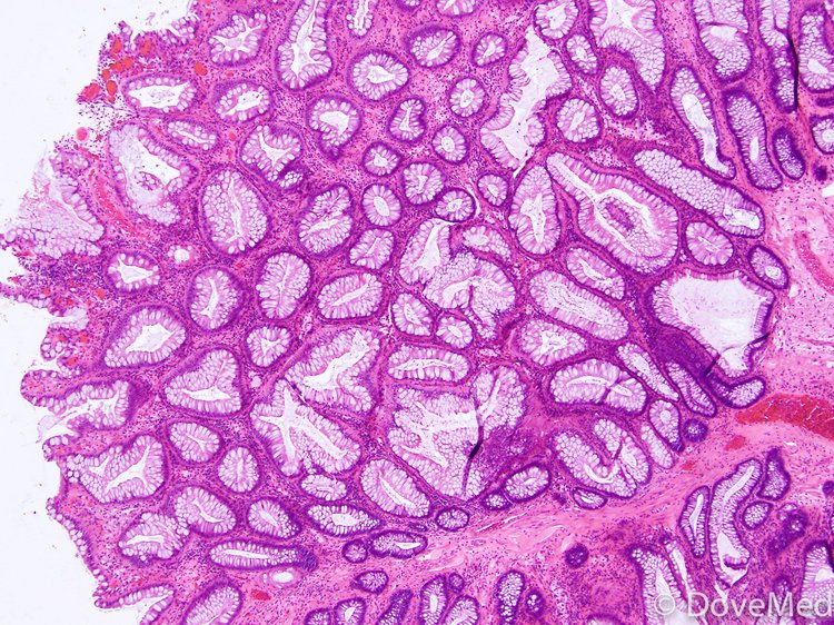 biopsy of anal polyp not removal Naked older women with big tits