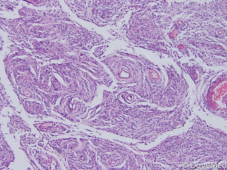 Meningothelial Meningioma