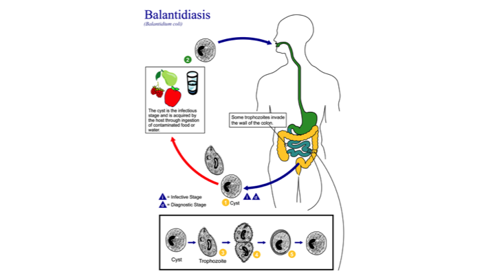 Balantidiasis