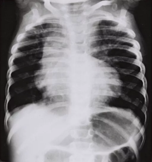 Infantile Scoliosis - DoveMed