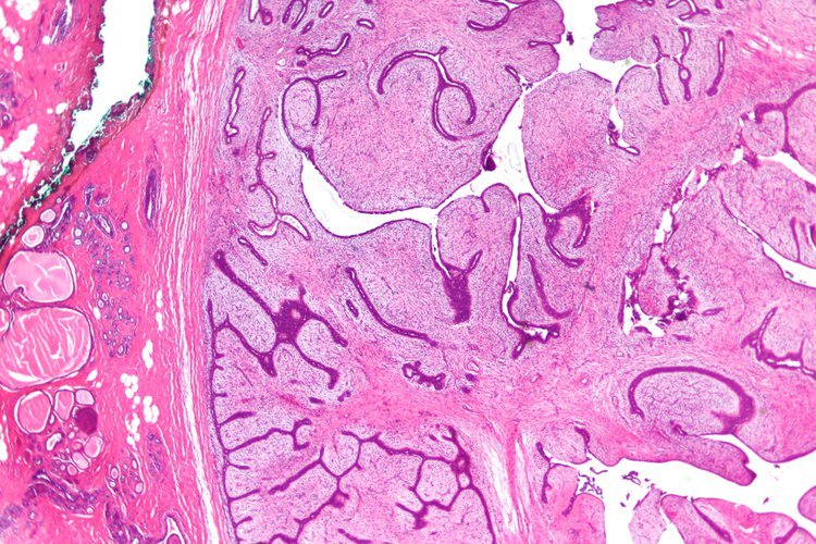 Phyllodes Tumor Of Breast