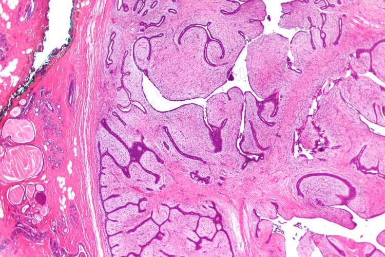 phyllodes-tumor-of-breast