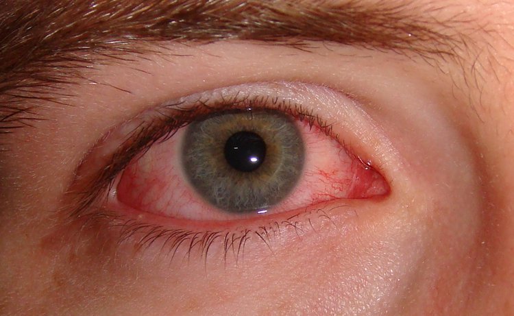 Conjunctivitis - General