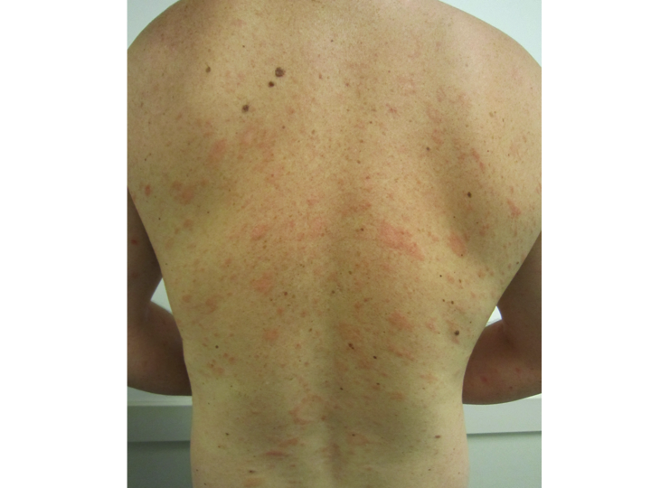 Pityriasis Rosea Treatment NYC - What is Pityriasis Rosea?