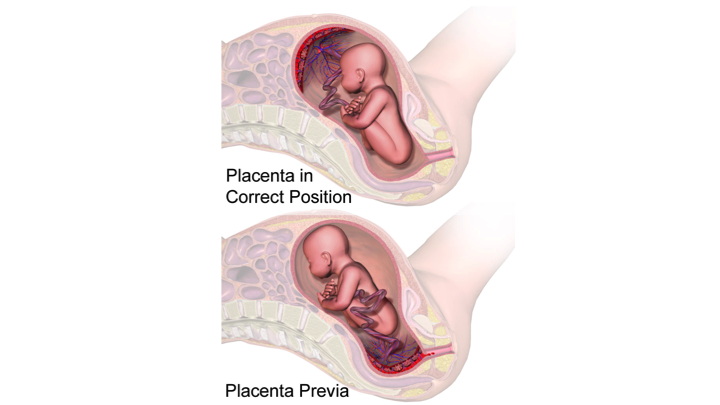 placenta-previa