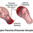 Placental Abruption.