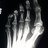 Plain X-ray of foot showing healing fractures of 2nd and 3rd metatarsal bones.