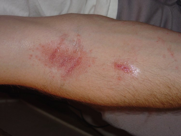 Poison Oak Rash