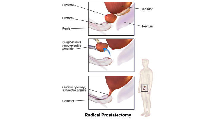 prostate gland surgery time cea mai recentă metodă de tratare a prostatitei