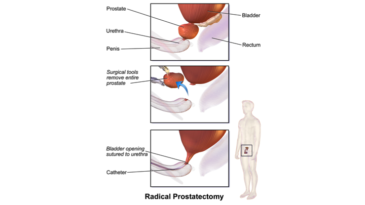 prostate gland surgery time