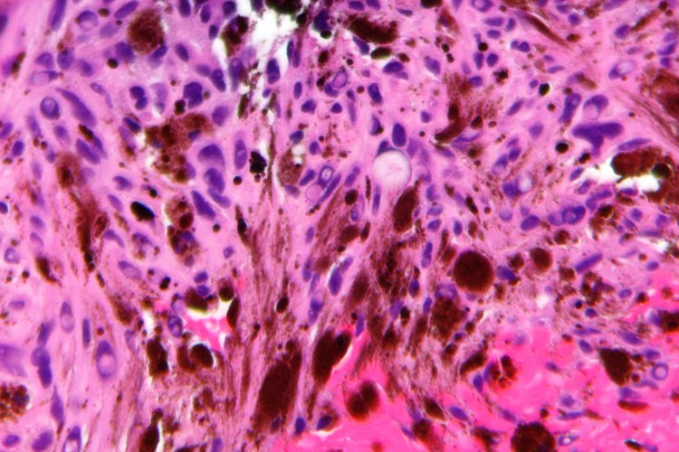 melanotic schwannoma pathology Psammomatous Melanotic Schwannoma