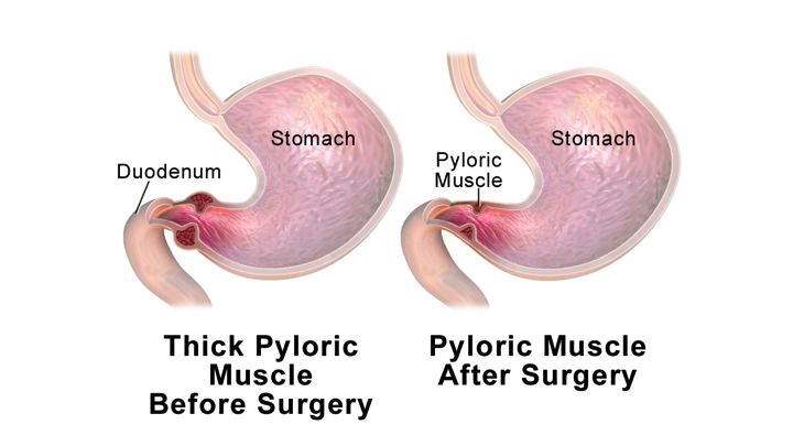 Pathophysiology Of Pyloric Stenosis In Flow Chart