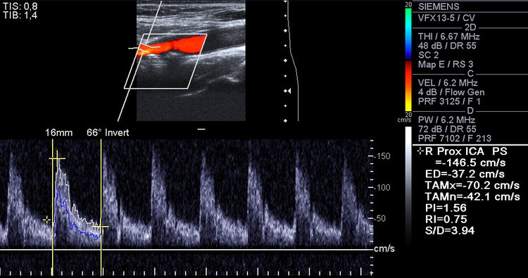 Carotid Artery Ultrasound