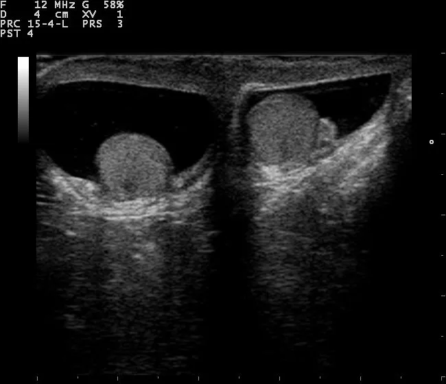 Ultrasound Imaging Of Scrotum Dovemed 6932