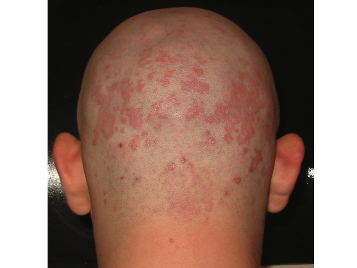 Seborrheic Dermatitis Of Skin