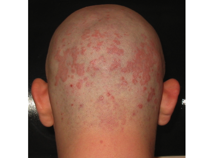 seborrheic-dermatitis-of-skin