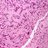 Microscopic pathology image showing Palisaded Encapsulated Neuroma (PEN). 20x.