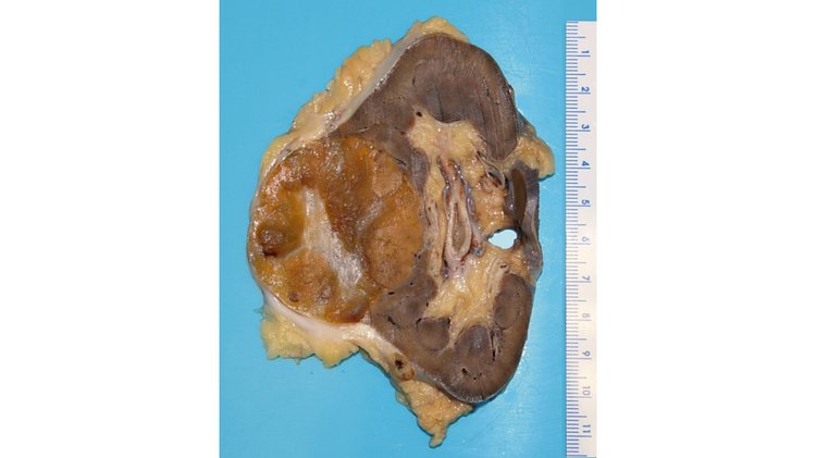 Oncocytoma of Kidney
