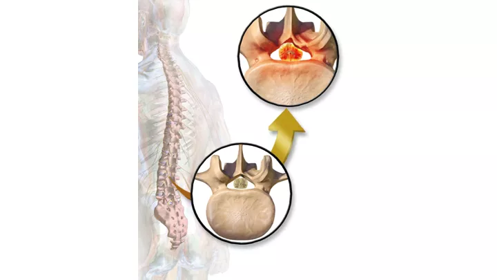 Spinal Stenosis  Diagnosing & Treatment Options: Progressive Spine &  Sports Medicine: Pain Medicine