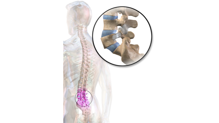 Spondylolysis