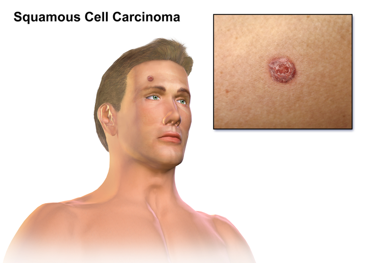 Squamous Cell Carcinoma Skin Cancer Types