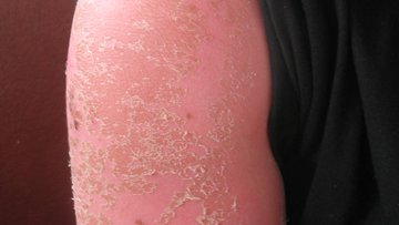 Sun burn
