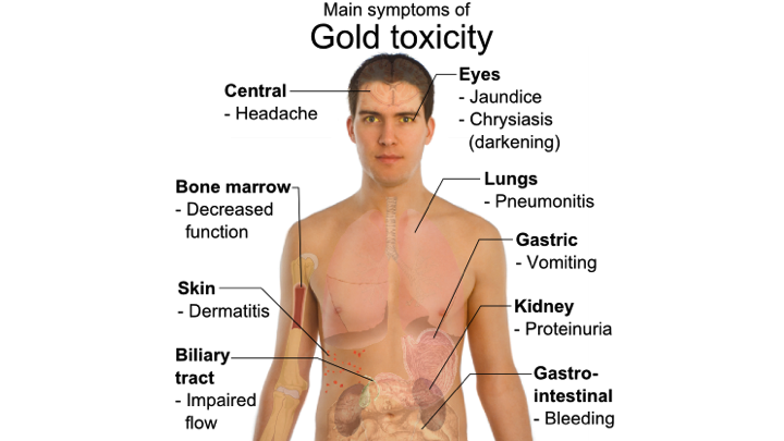 Gold Toxicity