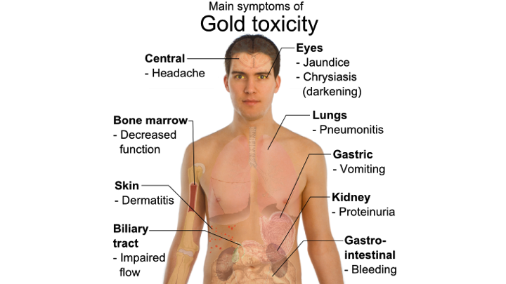 Tin toxicity, are you being poisoned by tin? Tin excess symptoms