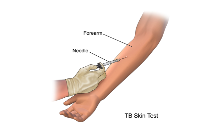 Uundgåelig Accord Rosefarve Tuberculin Skin Test for Tuberculosis