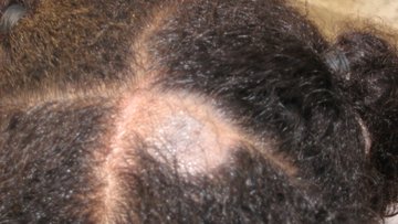 Tinea capitis