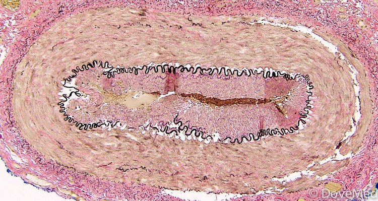 Giant Cell Arteritis (GCA)