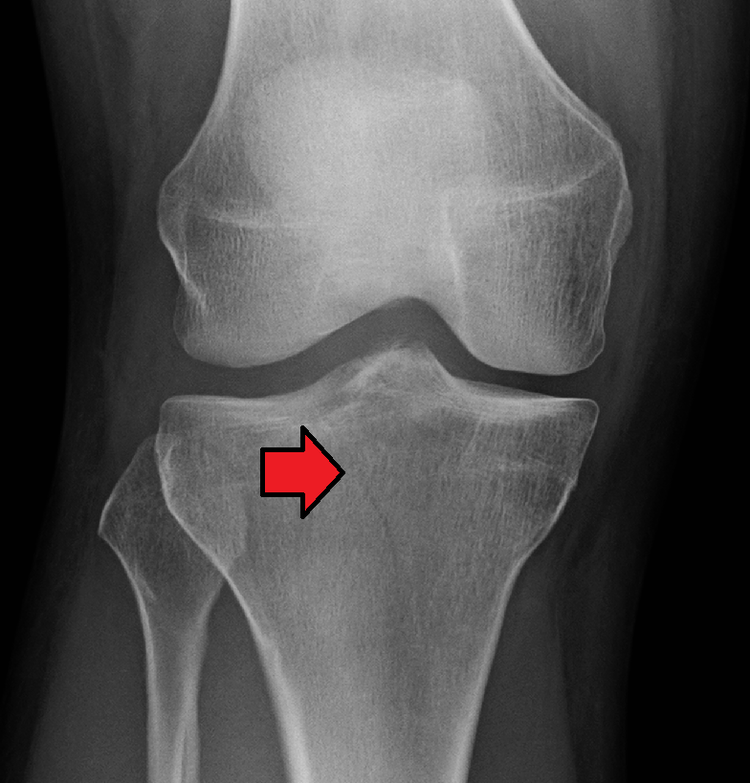 broken knee bone