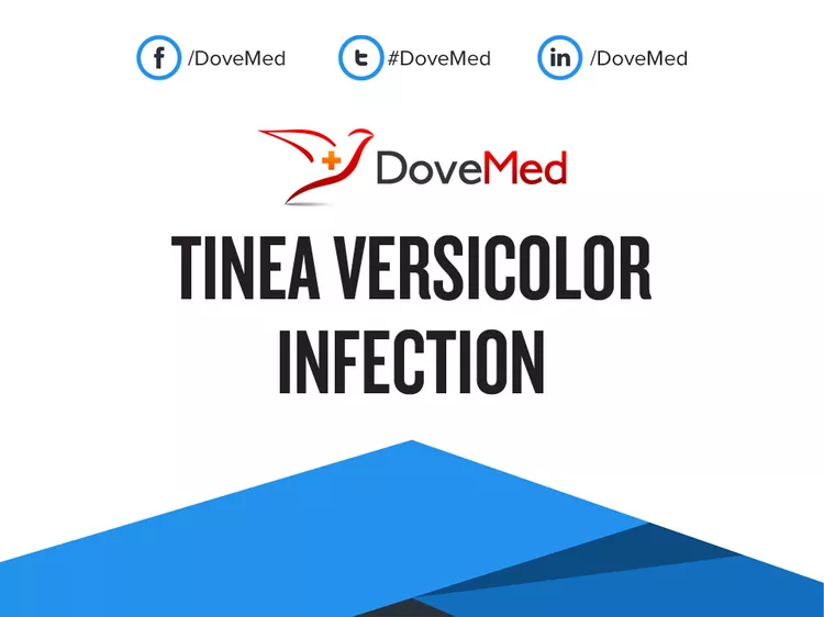 Tinea versicolor human body with symptoms Vector Image
