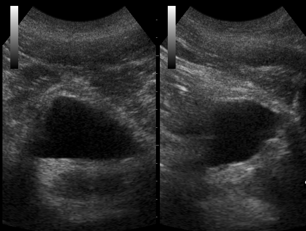 Ultrasound Imaging Prostate