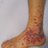 Image showing purpura on the low limb due to medication induced vasculitis.