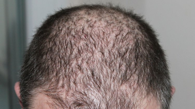 How Anxiety And Stress Can Cause Hair Loss