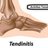Illustration of the Achilles' tendon with tendinitis