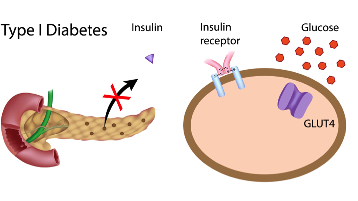 Importance Of Glucose Control In Adults With Type 1 Diabetes