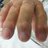 An individual showing Heberden's nodes in the fingers due to osteoarthritis.